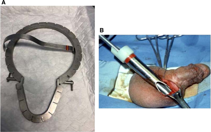 vibrating penis implant ZSI 475 FTM main image 0