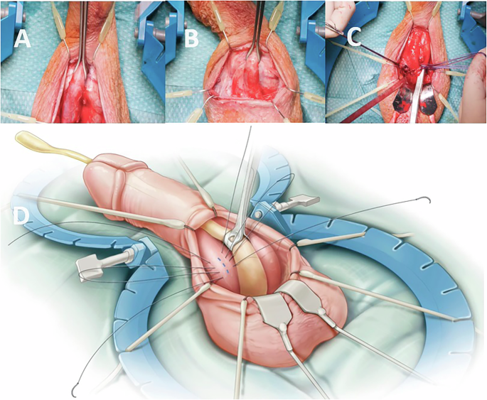 How to improve functional outcome of inflatable penile implant surgery? a  narrative review | International Journal of Impotence Research