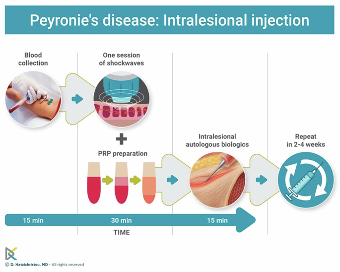 bpc 157 peyronie's disease What do we know about 'research only' peptides? Q&A with expert Stuart Phillips From fibrosis to restoration: the