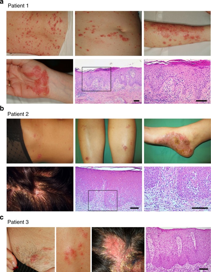 TNF blockade induces a dysregulated type I interferon response without  autoimmunity in paradoxical psoriasis | Nature Communications