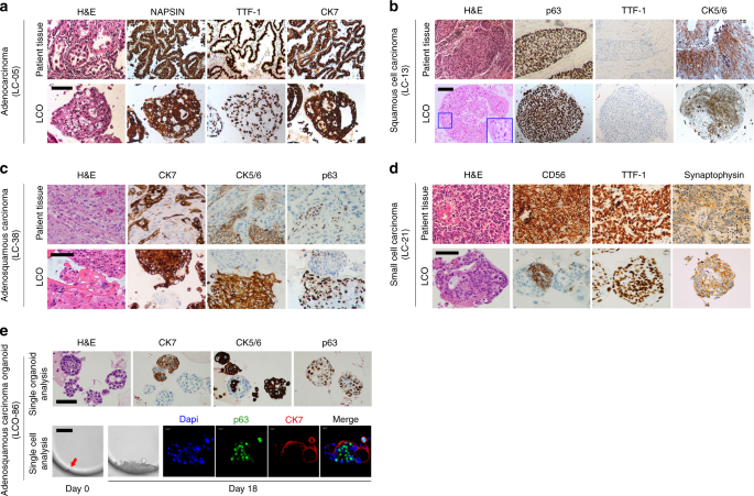 Patient Derived Lung Cancer Organoids As In Vitro Cancer Models For Therapeutic Screening Nature Communications