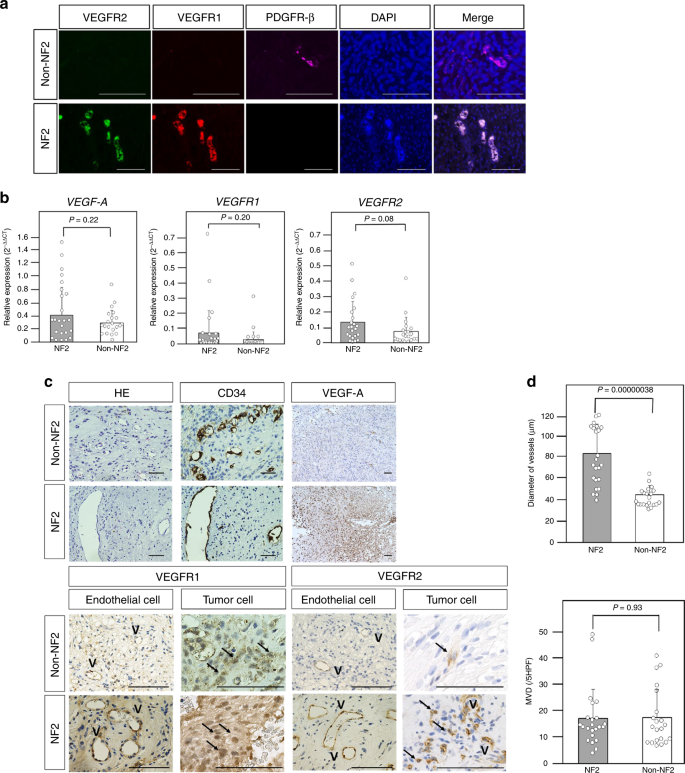 Fig. 3: Schwannomas in neurofibromatosis type 2 (NF2) and non-NF2 patients.