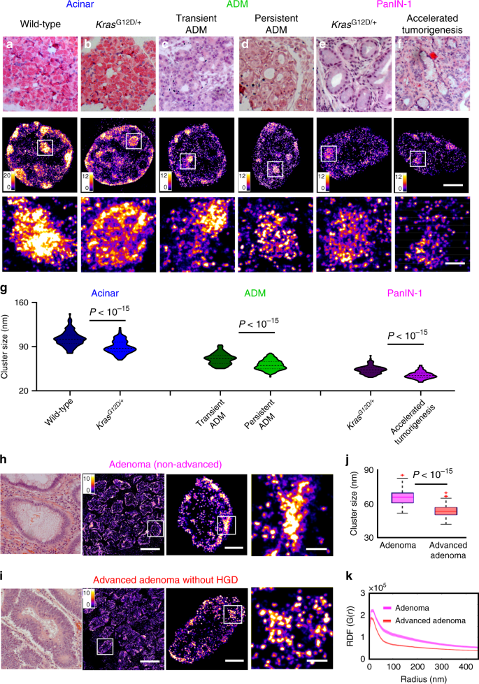 Fig. 7: Disrupted heterochromatin structure in precursors indistinguishable by conventional pathology.