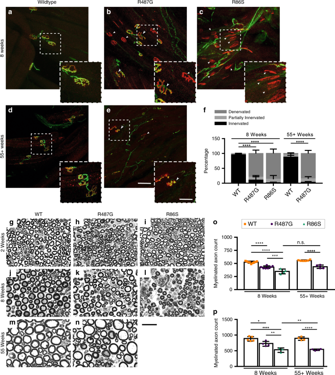 NEMF mutations that impair ribosome-associated quality control are ...