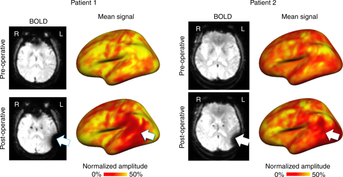 Fig. 7: Implanted electrode interference severely reduces BOLD signal amplitude.