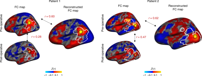 Fig. 8: The DCGAN model can reconstruct BOLD signals compromised by the implantation of a deep-brain stimulator in patients with Parkinson’s disease.