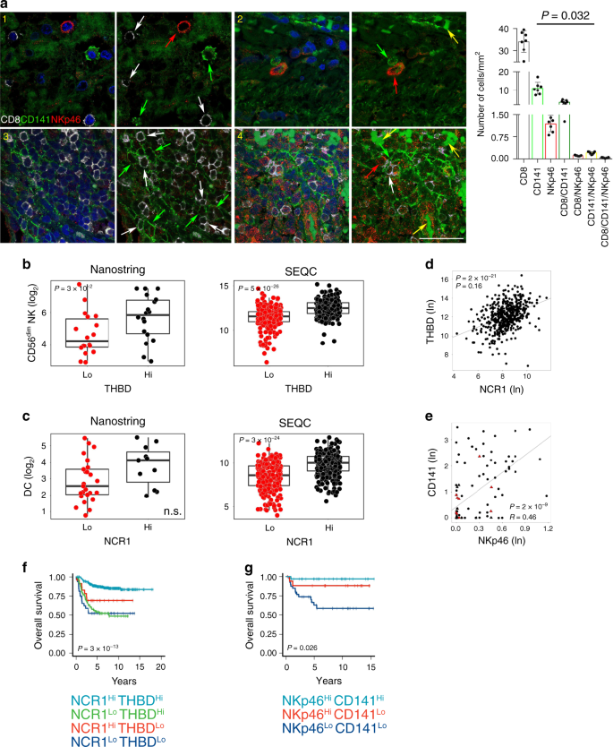 Fig. 5: Cross-correlation between intratumoral DCs and NK cells in human neuroblastoma.