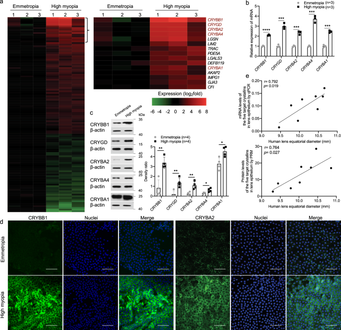 Fig. 2: Significant up-regulation of β/γ-crystallins was found in human with high myopia.