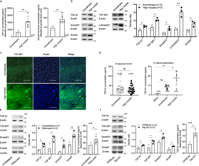Fig. 6: Aberrant activation of TGF-β1-Smads signaling in lens of high myopia.