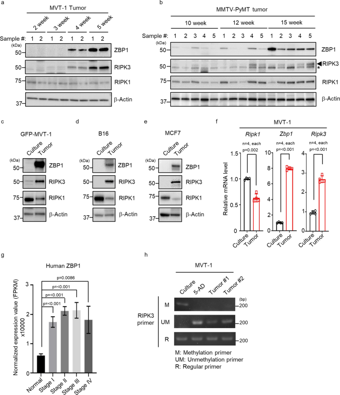 Fig. 2: ZBP1 is highly increased in late stage of mouse and human tumors.