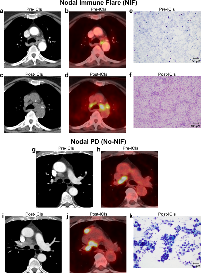 Fig. 1: Radiological and histopathological features of abnormal nodes following neoadjuvant ICIs.
