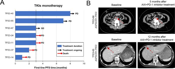 Fig. 6: Responses to systemic treatment and potential therapeutic targets for patients with TFE3-tRCC.