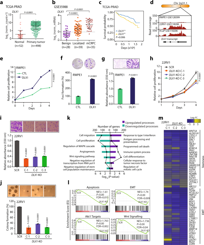Fig. 1: High DLX1 expression associates with poor prostate cancer prognosis and promotes disease progression.
