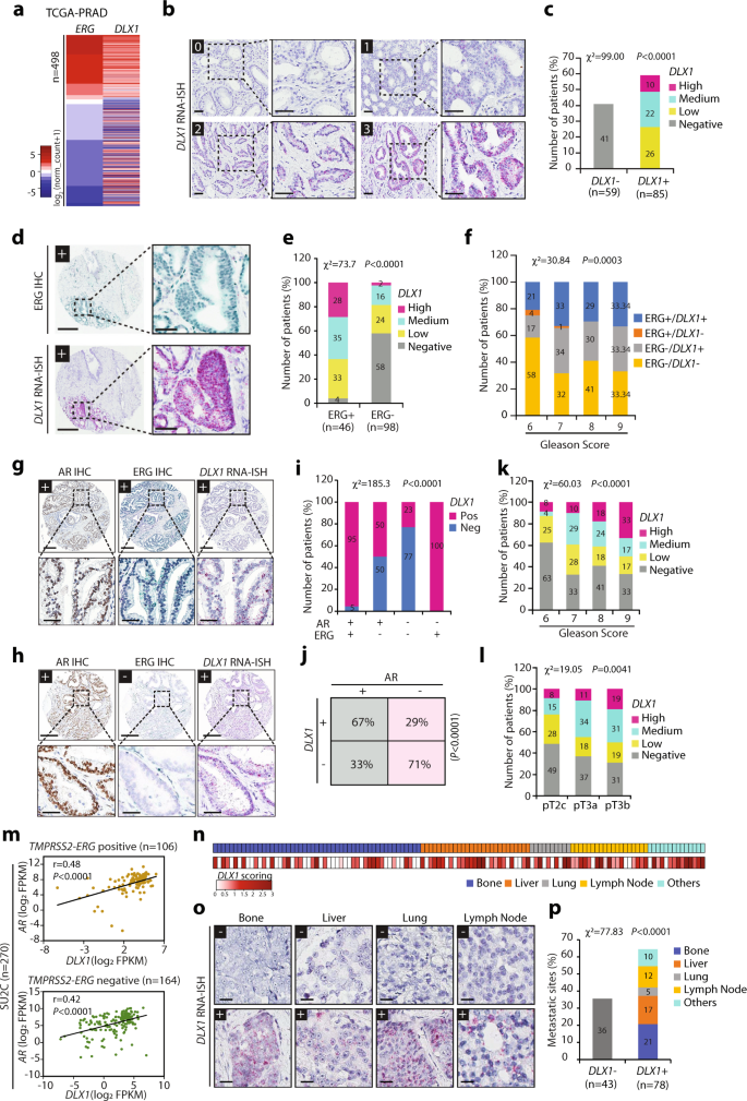 Fig. 4: Elevated ERG and AR correlates with higher DLX1 levels representing advanced-stage aggressive disease.