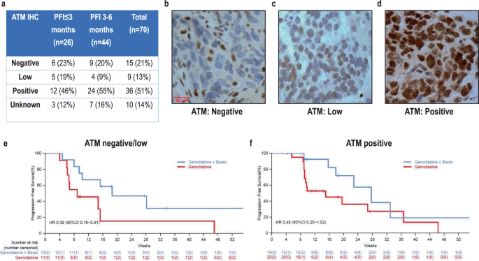 Fig. 1: Correlation of ATM expression via immunohistochemistry (IHC) with benefit of addition of berzosertib to gemcitabine.