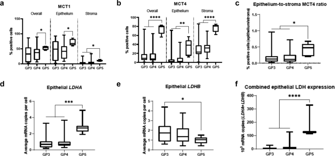 Fig. 4: Comparison of MCT1, MCT4, LDHA, LDHB, and combined epithelial LDHA and LDHB expression in malignant glands harbouring Gleason pattern 3, 4, and 5 disease.