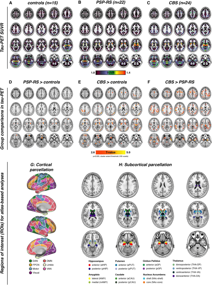 Tau deposition patterns are associated with functional connectivity in  primary tauopathies | Nature Communications