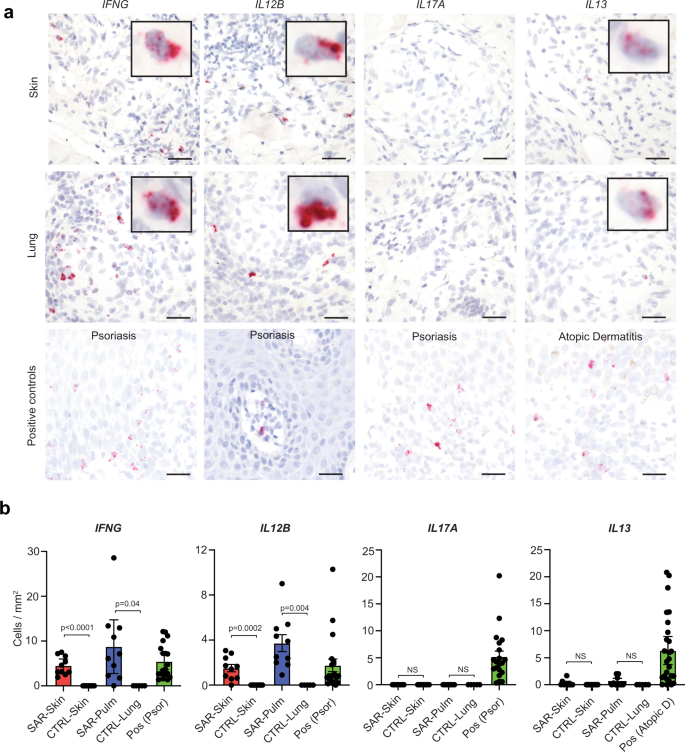 Fig. 7: Type 1 immunity is the predominant immune polarization in sarcoidosis.