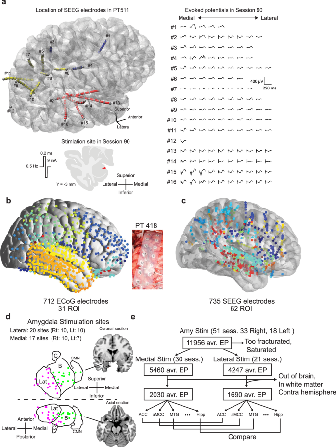 Fig. 1: Electrical stimulation tract tracing (es-TT) in epilepsy patients.