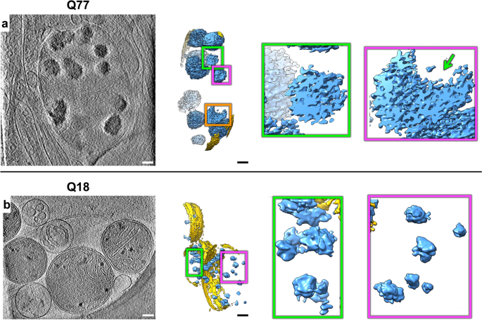 Fig. 2: Mitochondria in HD neurites contain enlarged granules composed of tightly packed, heterogeneous densities.