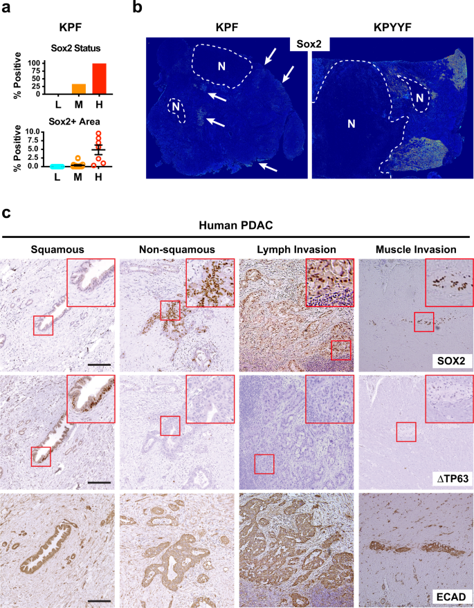 Fig. 2: Advanced Yap-expressing murine and human PDAC tumors spontaneously develop “progenitor” niches that express PTFs.
