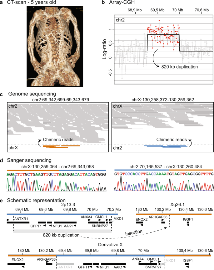 Fig. 1: Extreme case of heterotopic ossification.