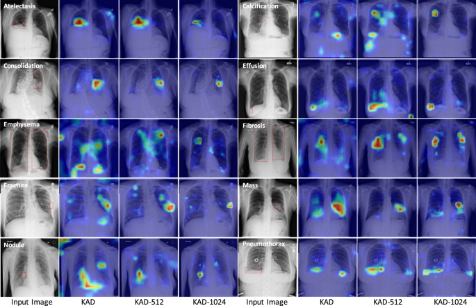 Fig. 6: Zero-shot visualization of randomly chosen samples from ChestX-Det10, we present both the original image (left) and attention maps generated from KAD, KAD-512, and KAD-1024.