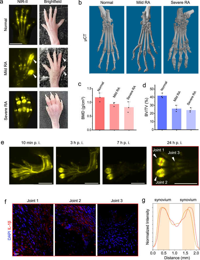 Fig. 4: Early recognition of rheumatoid arthritis (RA) through accurate inflammation NIR-II imaging.