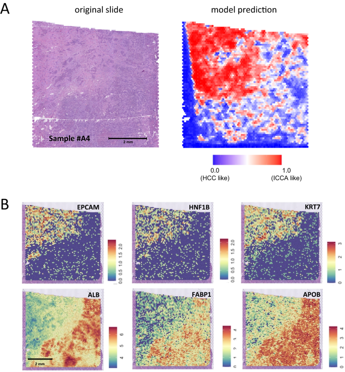 Fig. 4: Combination of deep-learning heatmaps with spatial transcriptomics unravels the gene expression profile of areas that markedly impact the predictions.