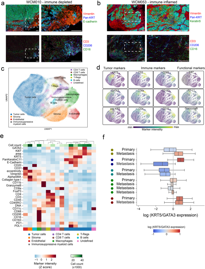 Fig. 5: Imaging Mass Cytometry™ reveals intra-patient concordance in molecular subtype plasticity between primary and metastatic UTUC tumors at the single cell level.
