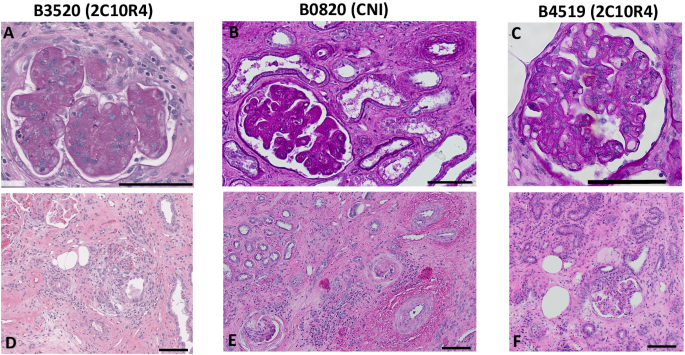 Fig. 3: Three of five xenograft recipients with histologic evidence of rejection at time of necropsy.