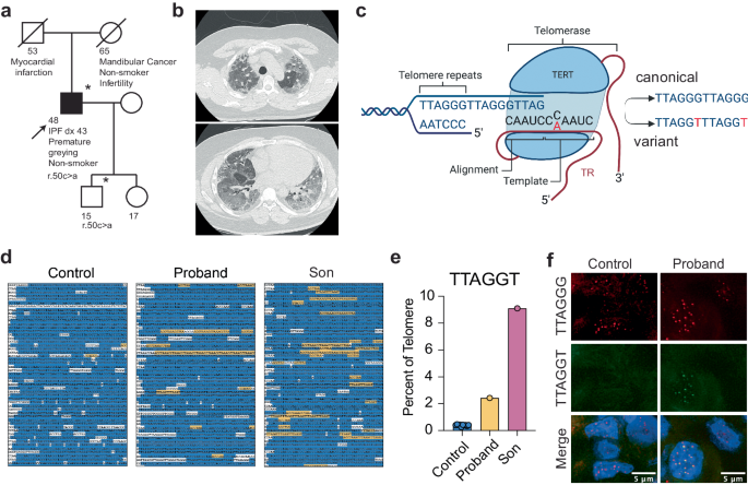 Fig. 1: A variant in telomerase RNA template alters the canonical telomere sequence.