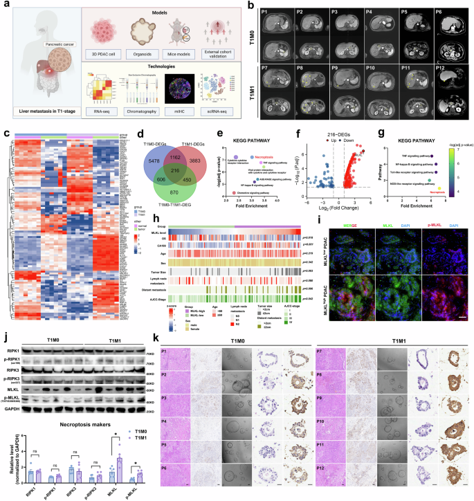 Fig. 1: Aberrant MLKL elevation-mediated necroptosis is associated with liver metastasis of early T stage PDAC.