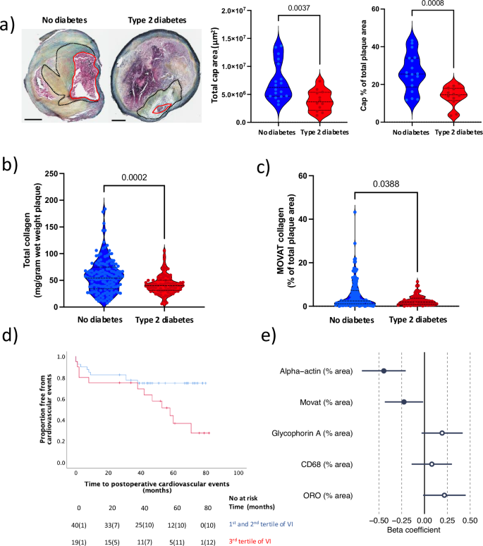 Fig. 1: Less collagen and vascular smooth muscle cells are associated with future cardiovascular events in type 2 diabetes .