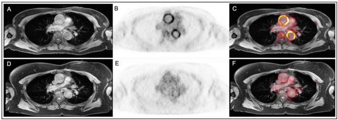 Fig. 7: Example of reduction in FDG uptake from baseline to follow-up.