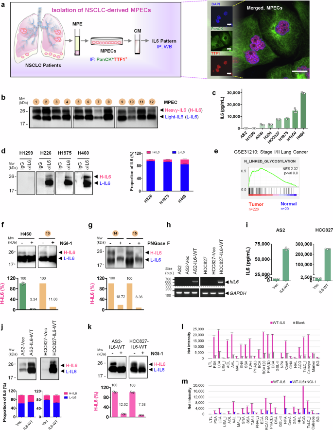 Defective N-glycosylation of IL6 induces metastasis and tyrosine 