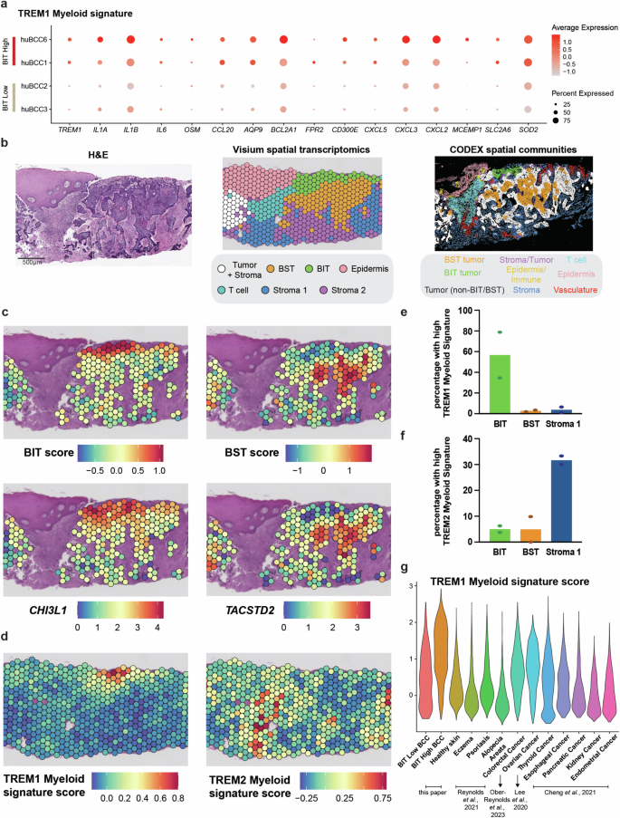 Fig. 5: BIT tumor epithelium arises in a specialized inflammatory environment defined by tumor-associated TREM1 myeloid cell gene signature.