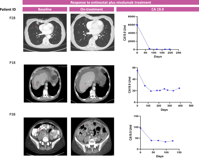 Fig. 3: Radiologic scans and change in CA19.9 of the three responders during the course of entinostat plus nivolumab therapy.
