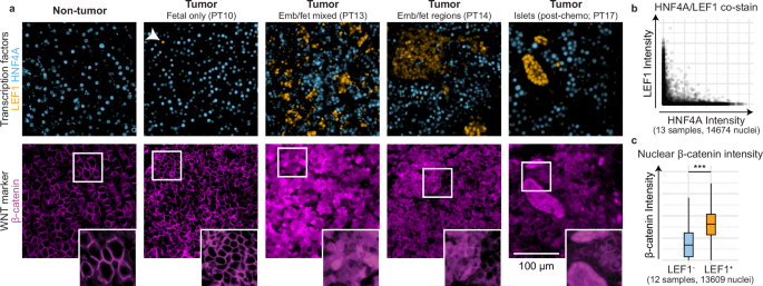 Fig. 3: Immunofluorescence staining of TFs LEF1 and HNF4A mark distinct tumor subpopulations.