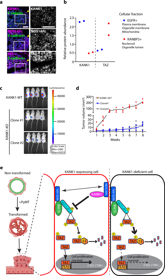 Fig. 10: KANK1 in human breast cancer.