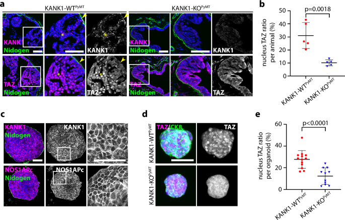 Fig. 9: Junctional translocation of KANK1 promotes nuclear TAZ accumulation in malignant tissues.