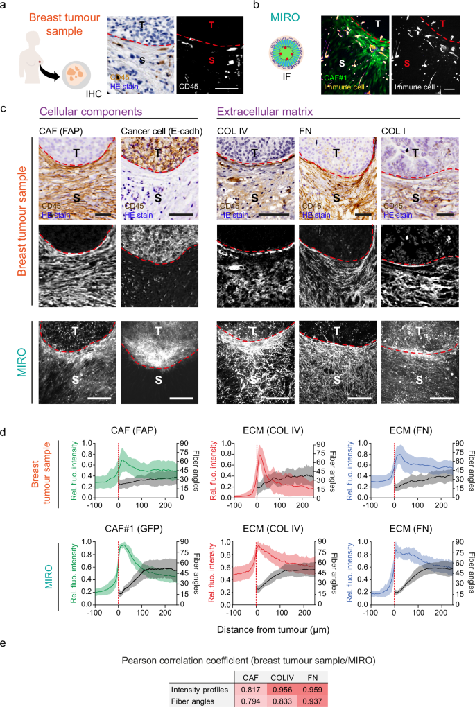 Fig. 2: MIRO co-culture creates spatial features of the tumour/stroma boundaries found in tumour beast patient samples.