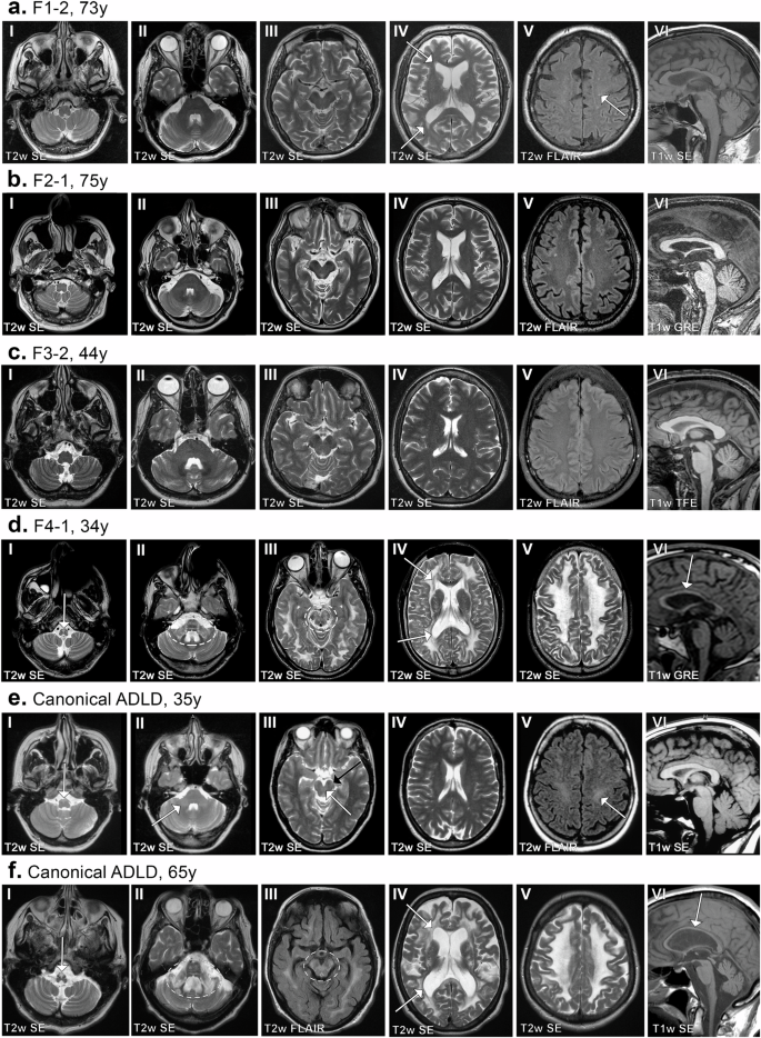 Fig. 1: MR image series of subjects with LMNB1 duplications.