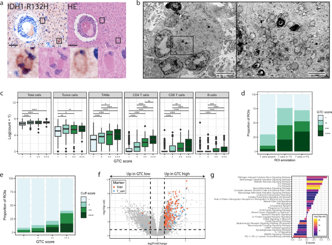Fig. 2: Gemistocytic tumor cells are localized in tumor stroma surrounding T cell cuffs and associate with the accumulation of immune cells.