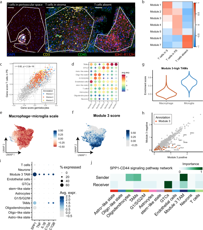 Fig. 4: Gemistocytic tumor cells co-localize with immune-reactive TAMs.