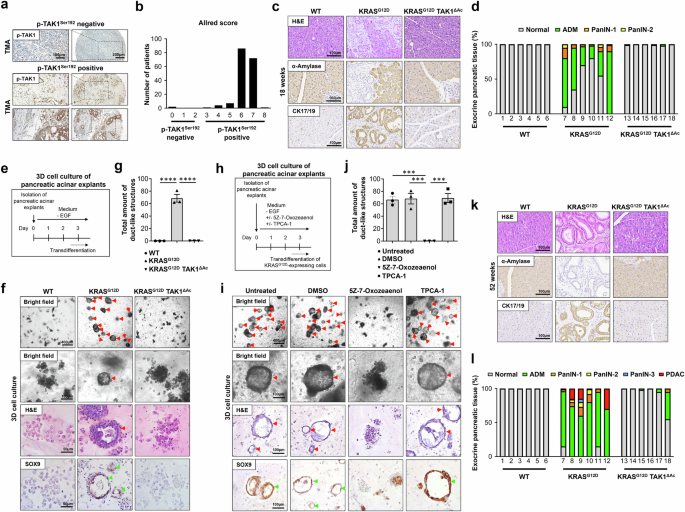 Fig. 1: TAK1 supports KRASG12D-driven ADM and PanIN formation resulting in PDAC development.