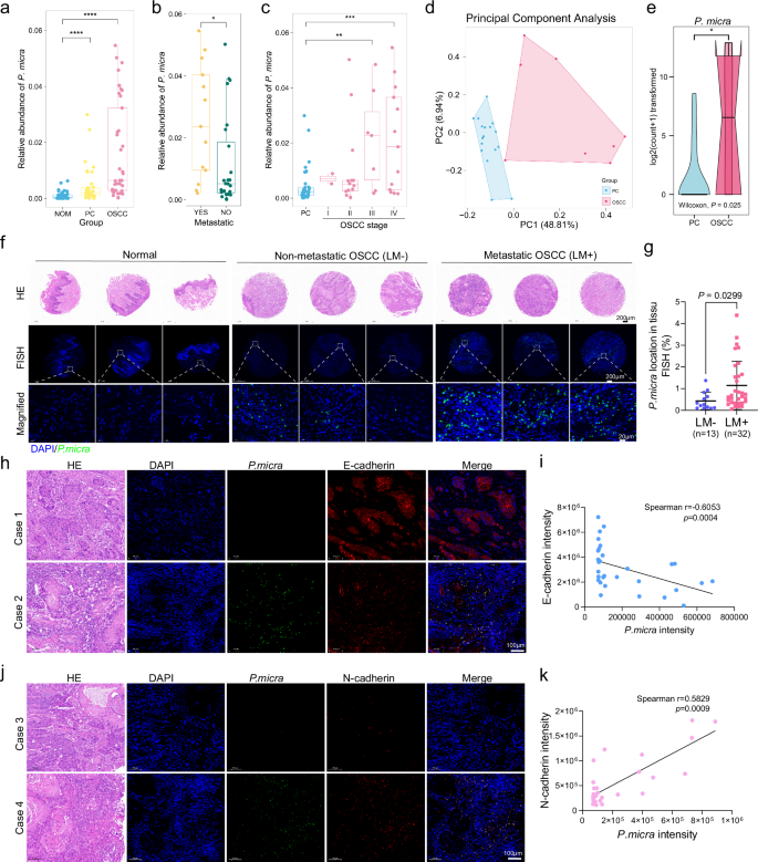 Fig. 1: P. micra enriched in OSCC tissue and correlated with OSCC metastasis.