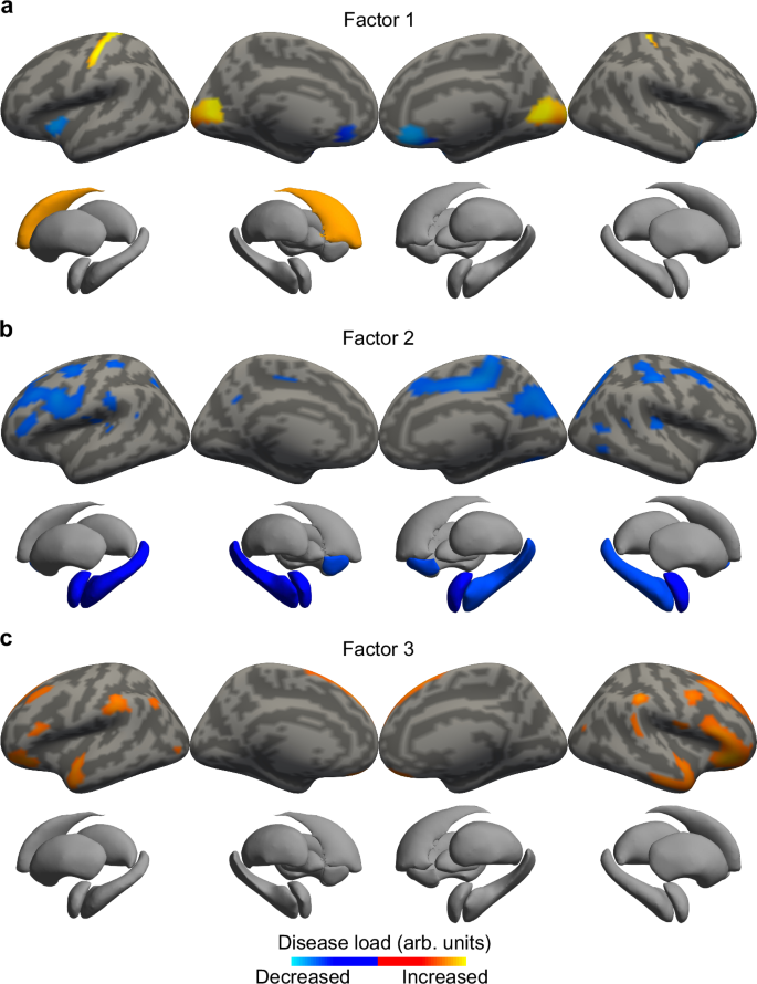 Major depressive disorder on a neuromorphic continuum | Nature ...