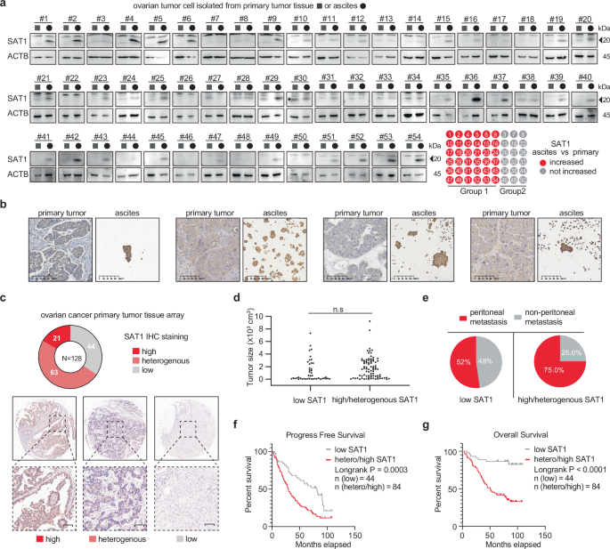 Fig. 2: SAT1 expression is correlated with peritoneal metastasis in ovarian cancer.