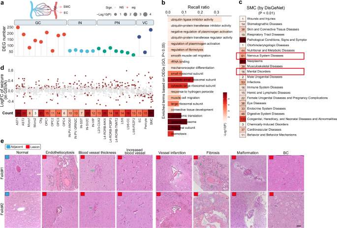 Fig. 2: Vasculature aberration is a dominant feature of the neocortex of the FCDIIb lesions.